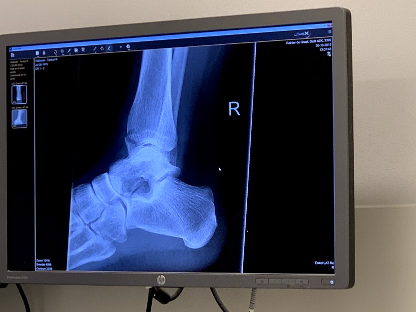 A bad bike accident and broken ankle